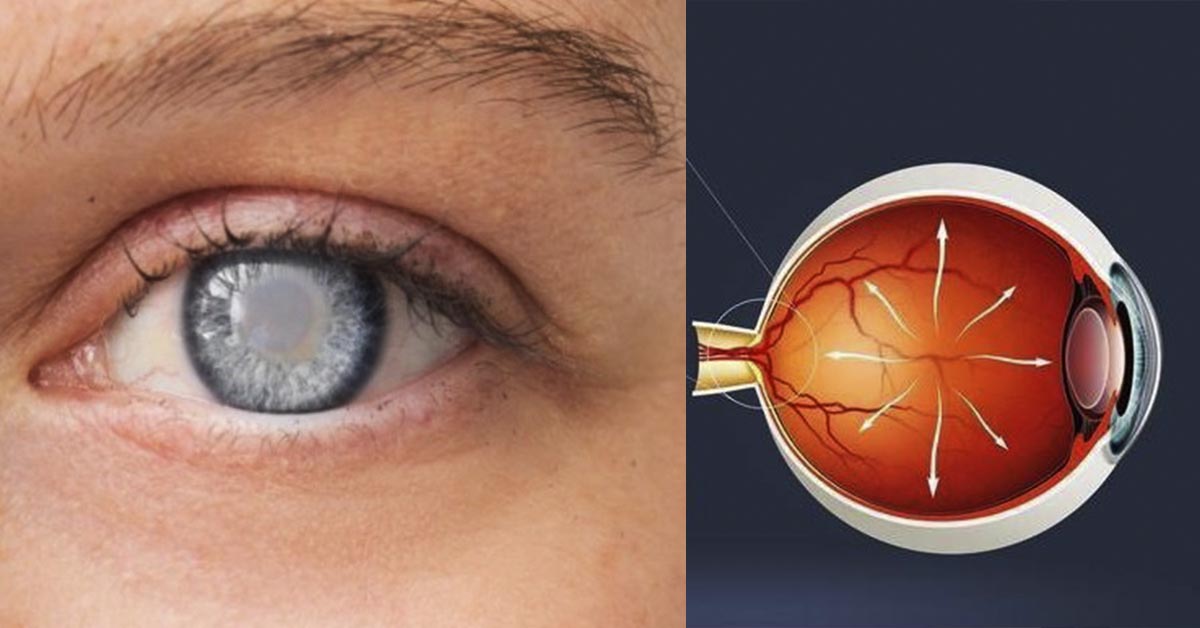 Глаукома: диагностика, лечение и перспективы Glaukoma